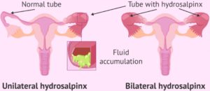 fertility, infertility, fibroid, IVF, Fallopian tube