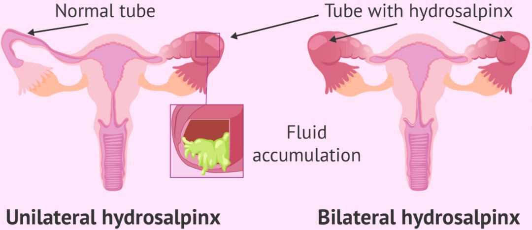 HYDROSALPINX » The Medison Hostpital