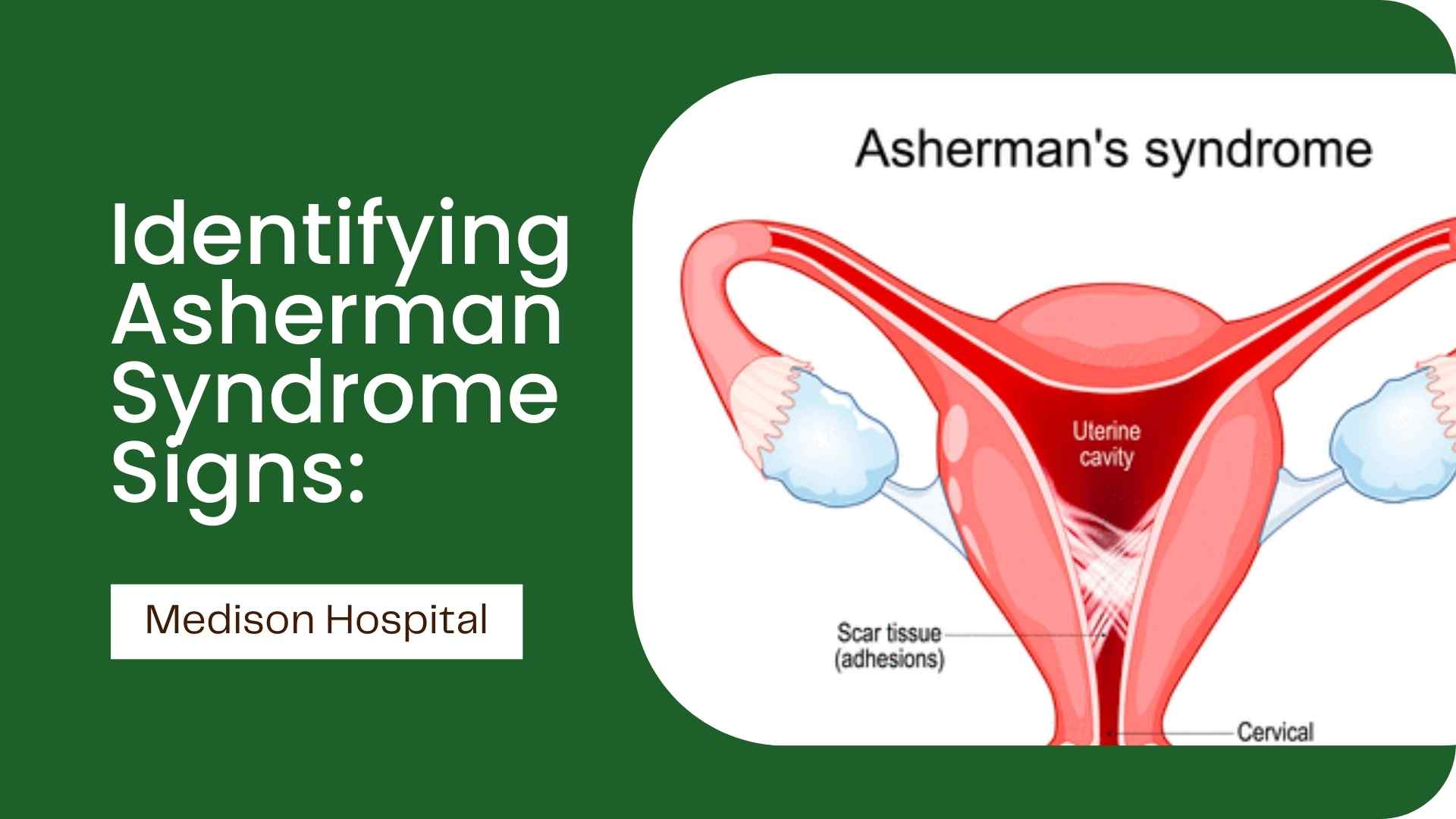 Asherman Syndrome Signs