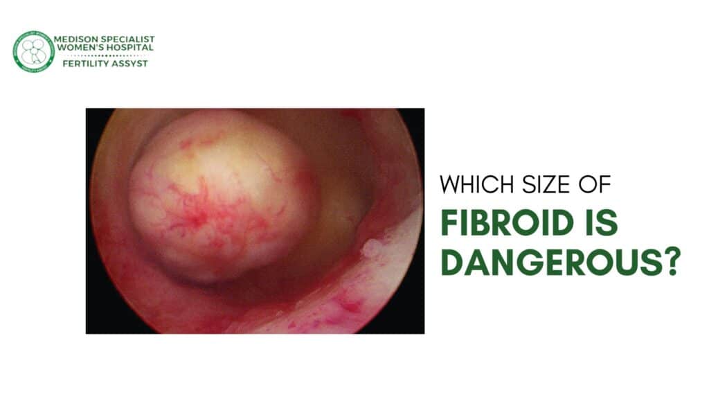 Fibroid is Dangerous what size