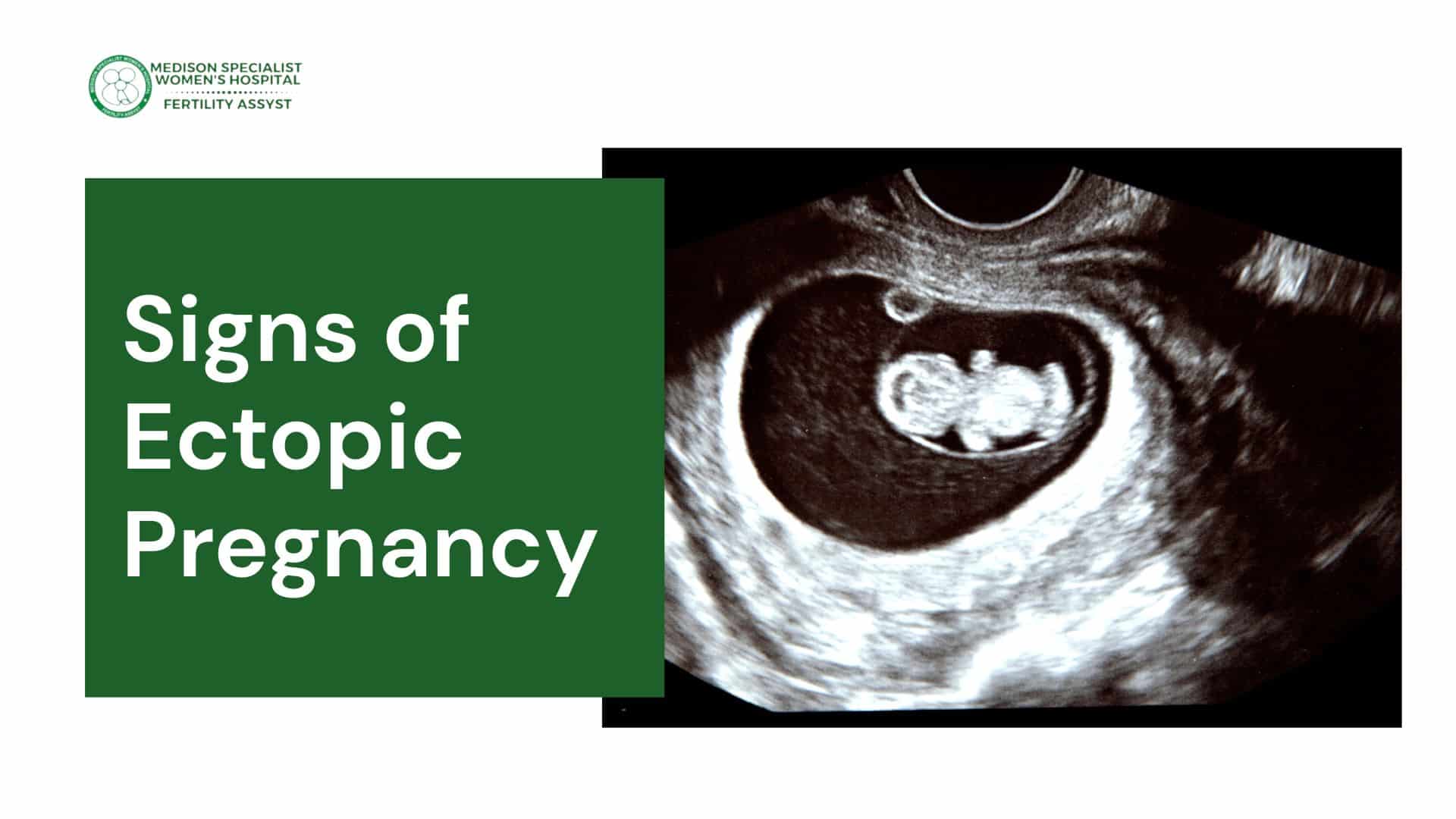 Signs of Ectopic Pregnancy 